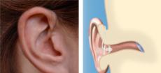 Open-Ear Open-Fit Hearing Aids
